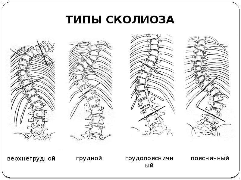 Степени сколиоза в картинках