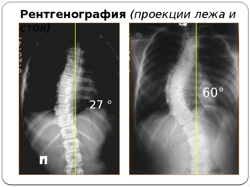 Сколиоз на рентгене фото