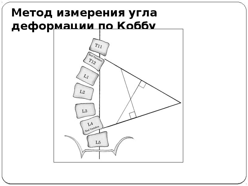 Угол кобба. Измерение угла сколиоза по коббу. Метод Кобба сколиоз степени. Классификация сколиоза по коббу рентген. Угол Кобба степени сколиоза.