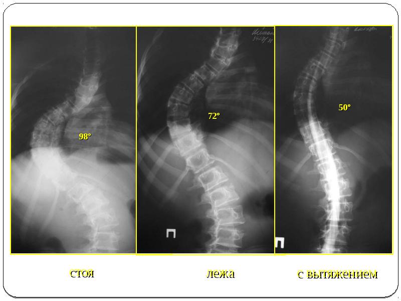Рентген сколиоз 4 степени фото