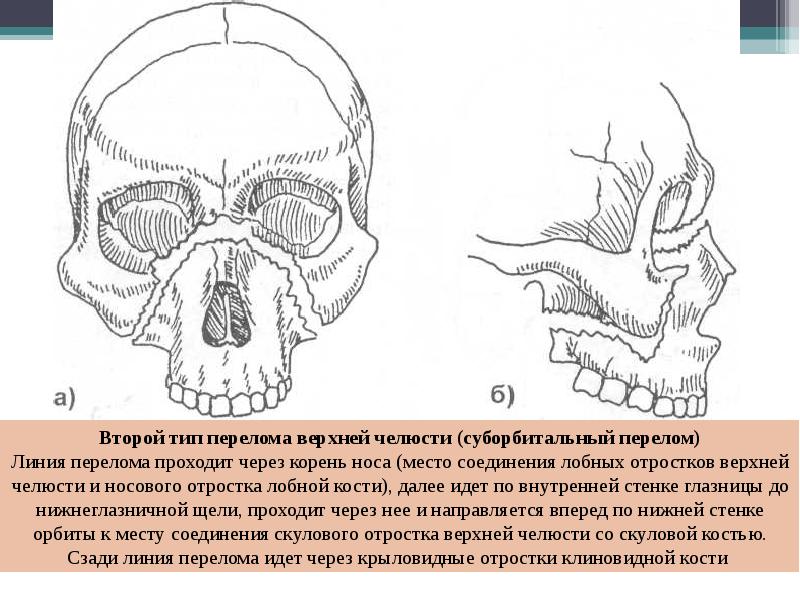 Перелом верхней челюсти презентация