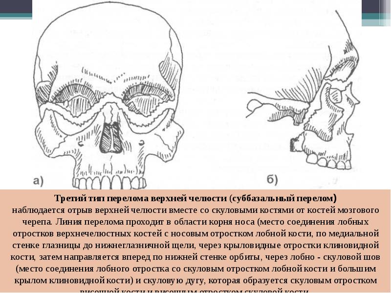 Перелом верхней челюсти картинки