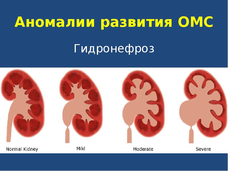 Гидронефроз у детей презентация