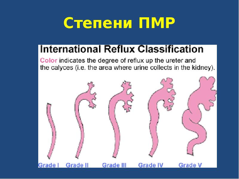 Пузырно мочеточниковый рефлюкс у детей презентация