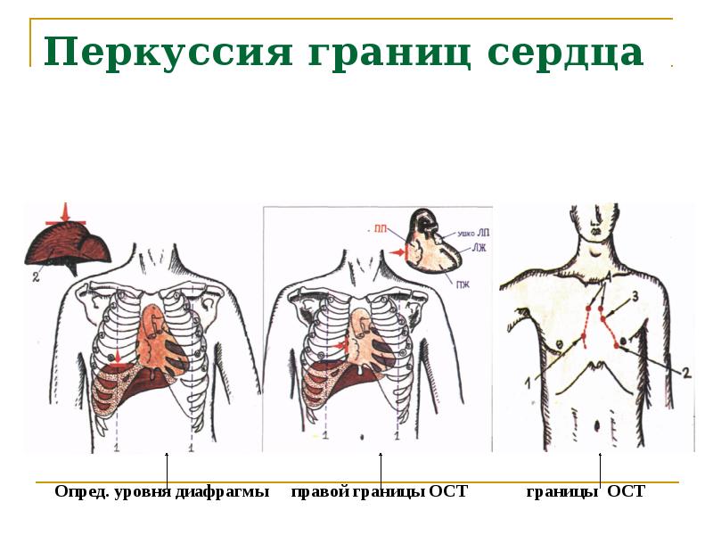 Верхняя граница сердца в норме. Перкуссия сердца пропедевтика. Перкуссия сердца пропедевтика границы. Перкуссия ССС пропедевтика. Перкуссия сердца пропедевтика у детей.