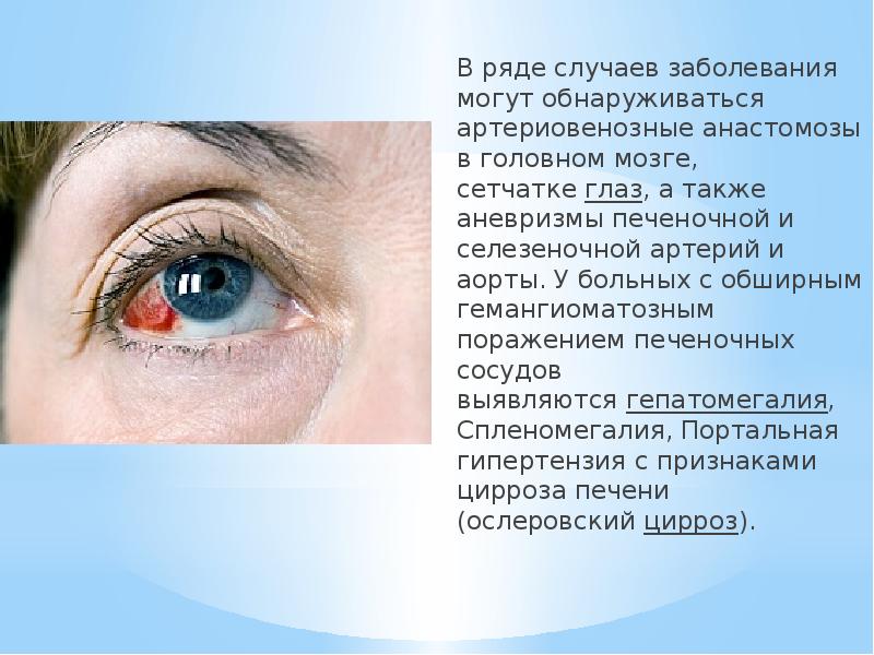 В ряде случаев заболевания могут обнаруживаться артериовенозные анастомозы в головном мозге,