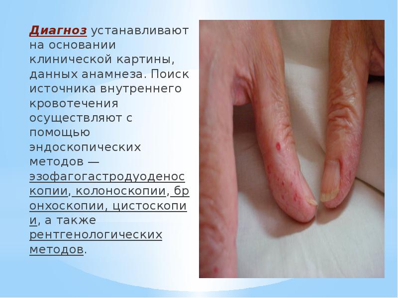 Диагноз&nbsp;устанавливают на основании клинической картины, данных анамнеза. Поиск источника внутреннего кровотечения