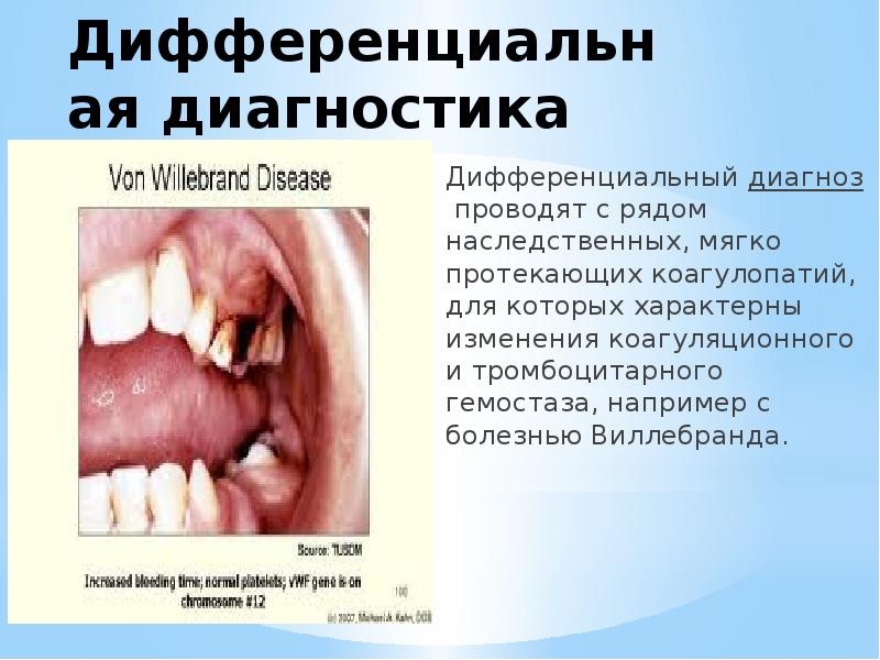 Дифференциальная диагностика Дифференциальный&nbsp;диагноз&nbsp;проводят с рядом наследственных, мягко протекающих коагулопатий, для которых