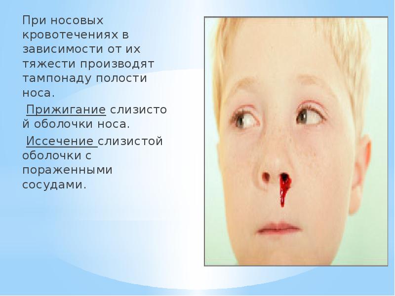 Лечение При носовых кровотечениях в зависимости&nbsp;от&nbsp;их тяжести производят тампонаду полости носа.