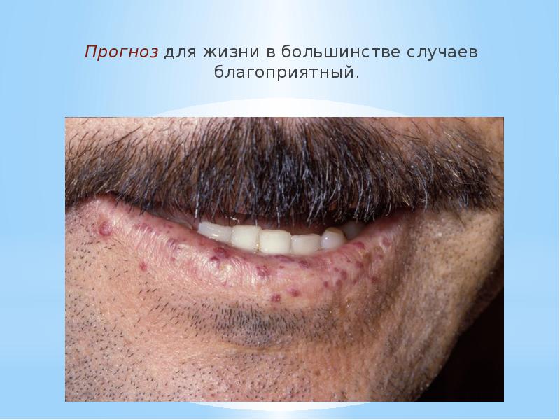 Прогноз&nbsp;для жизни в большинстве случаев благоприятный. Прогноз&nbsp;для жизни в большинстве случаев