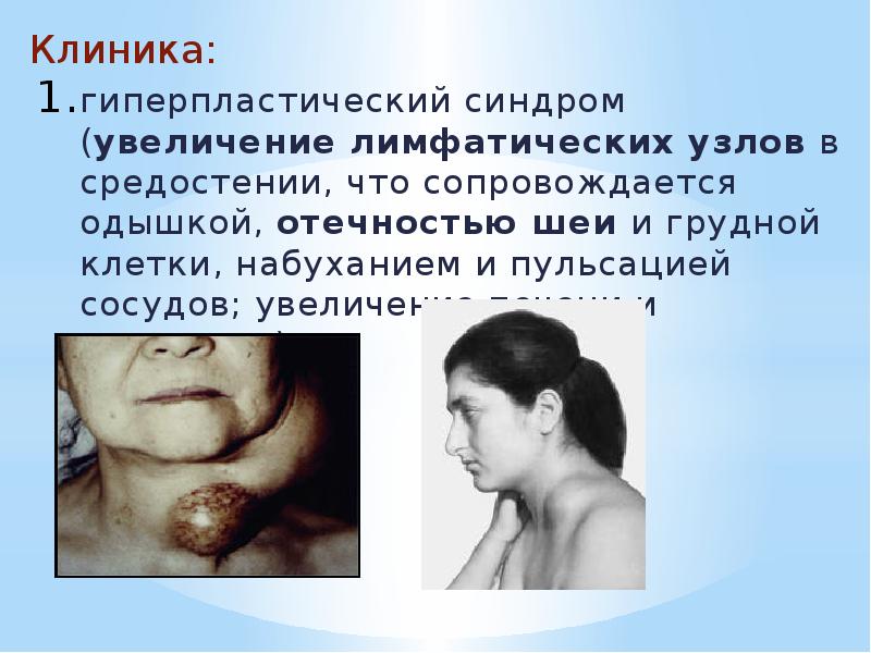 Клиника: Клиника: гиперпластический синдром (увеличение лимфатических узлов в средостении, что сопровождается