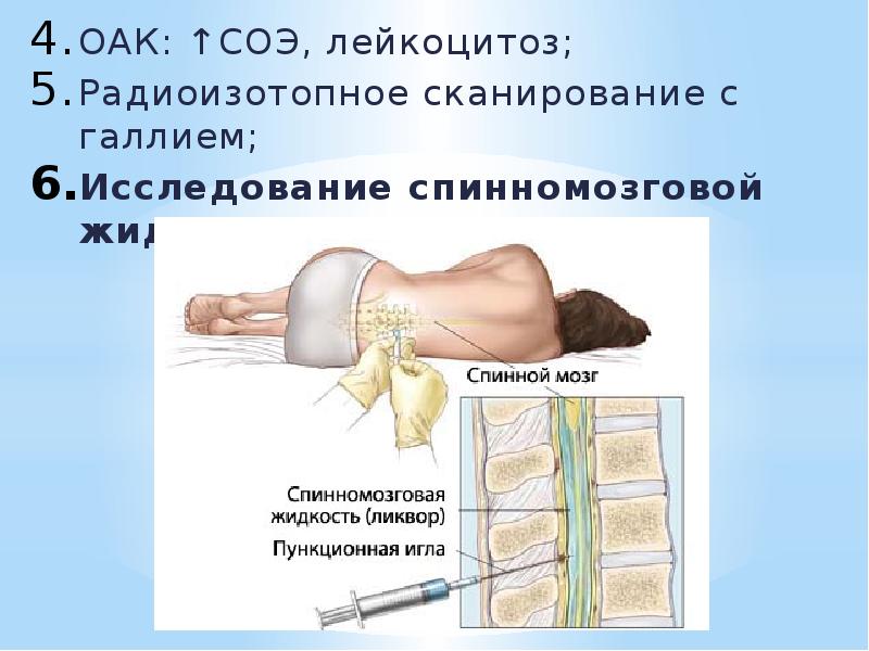 ОАК: ↑СОЭ, лейкоцитоз; ОАК: ↑СОЭ, лейкоцитоз; Радиоизотопное сканирование с галлием; Исследование