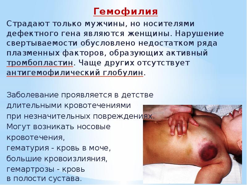 Гемофилия Гемофилия Страдают только мужчины, но носителями дефектного гена являются женщины.