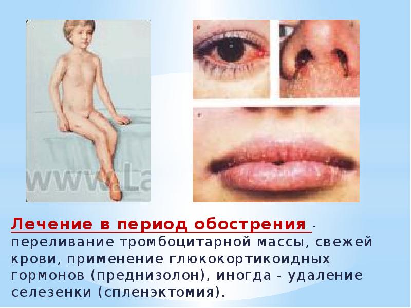 Лечение в период обострения - переливание тромбоцитарной массы, свежей крови, применение