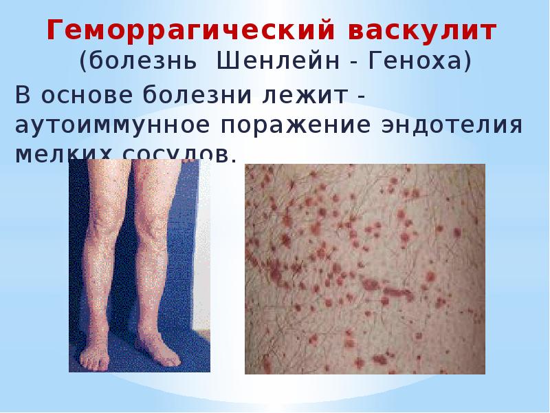 Геморрагический васкулит  (болезнь	Шенлейн - Геноха) Геморрагический васкулит  (болезнь	Шенлейн -