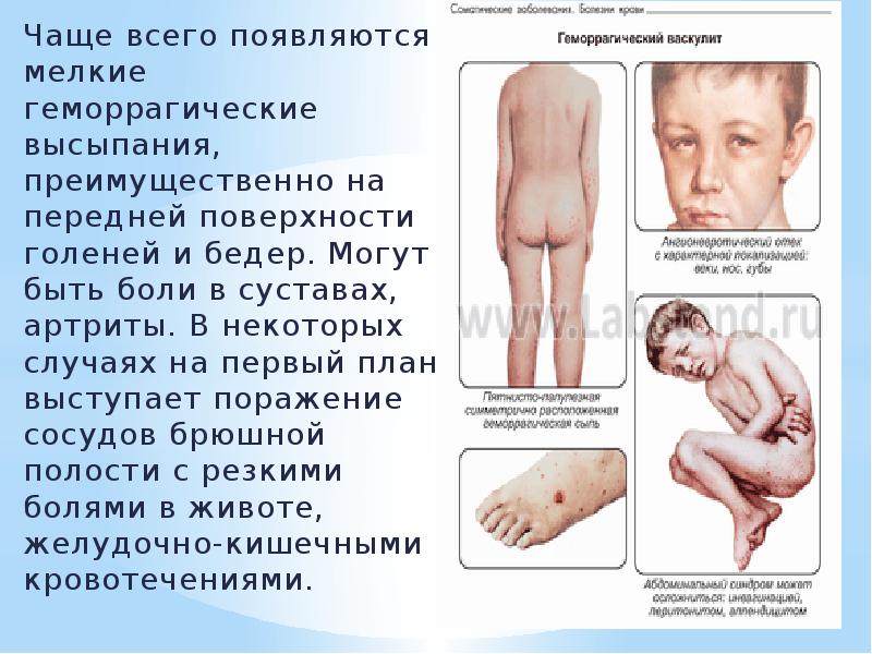 Чаще всего появляются мелкие геморрагические высыпания, преимущественно на передней поверхности голеней