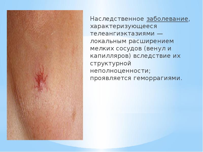Наследственное&nbsp;заболевание, характеризующееся телеангиэктазиями — локальным расширением мелких сосудов (венул и капилляров)