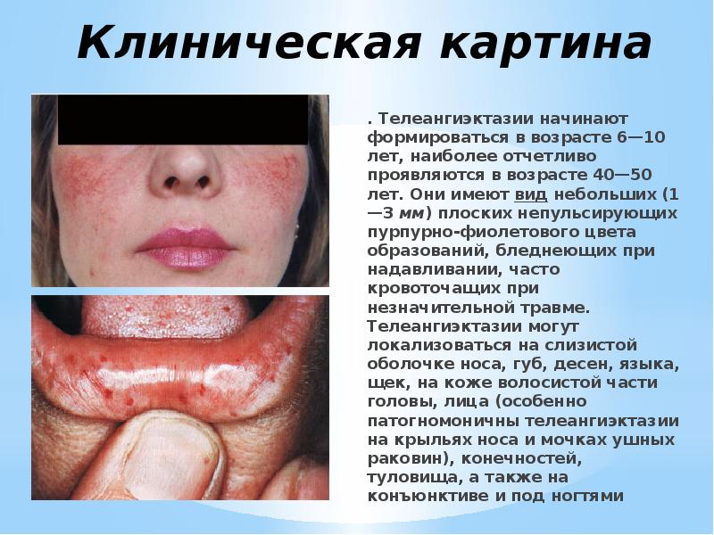Клиническая картина . Телеангиэктазии начинают формироваться в возрасте 6—10 лет, наиболее