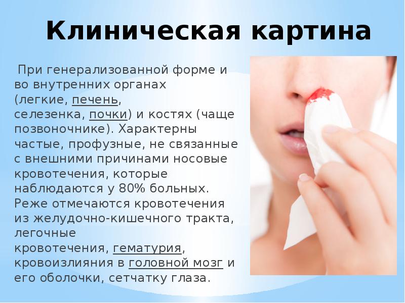 Клиническая картина &nbsp;При генерализованной форме и во внутренних органах (легкие,&nbsp;печень, селезенка,&nbsp;почки)