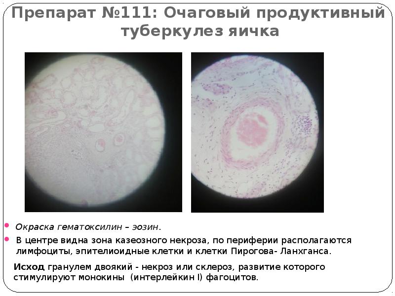 Препарат №111: Очаговый продуктивный  туберкулез яичка Окраска гематоксилин – эозин.