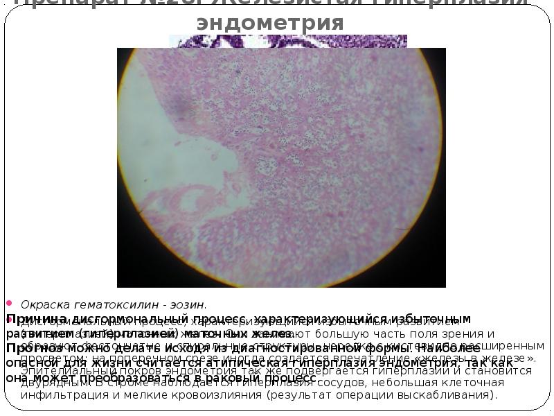 Препарат №28: Железистая гиперплазия эндометрия Окраска гематоксилин - эозин.  Дисгормональный
