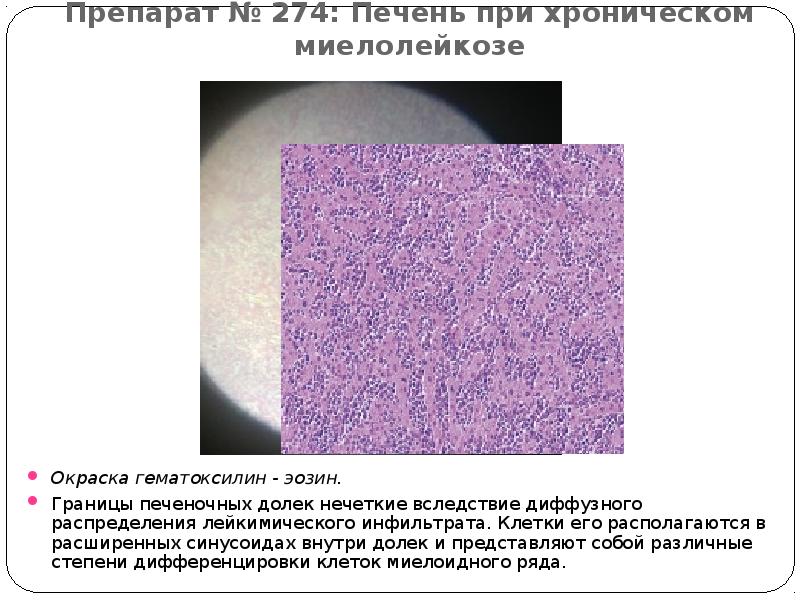 Препарат № 274: Печень при хроническом миелолейкозе Окраска гематоксилин - эозин.