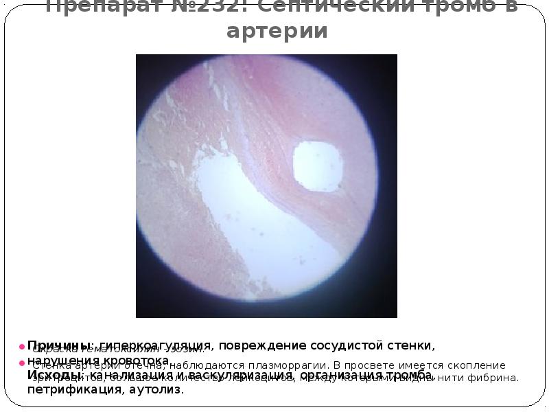 Препарат №232: Септический тромб в артерии  Окраска гематоксилин - эозин.