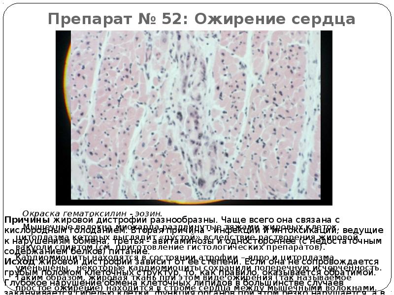 Жировая дистрофия миокарда