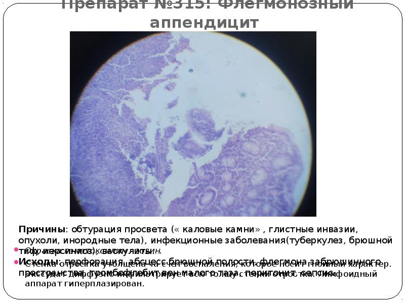 Препарат №315: Флегмонозный аппендицит  Окраска гематоксилин - эозин.  Стенка
