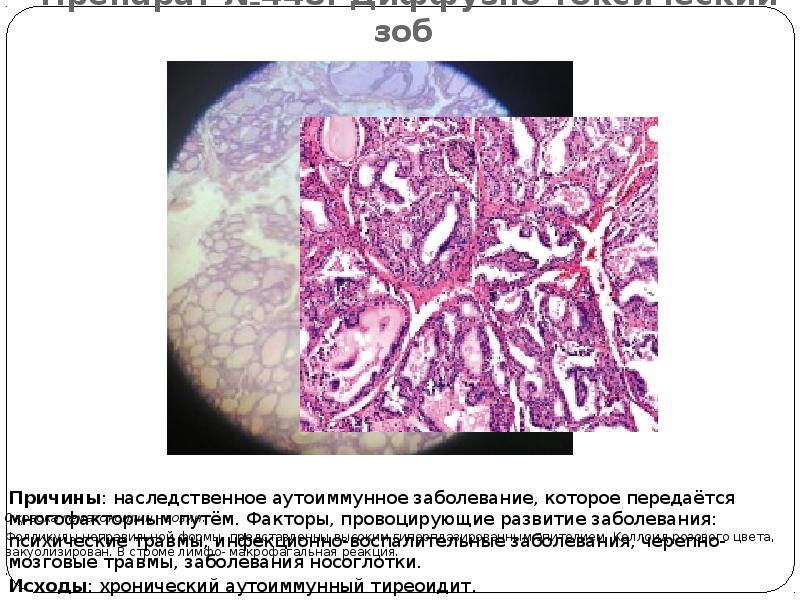 Препараты при дтз. Диффузный токсический зоб гистология. Гиперплазия щитовидной железы микропрепарат. Диффузный препарат. Простая диффузия.