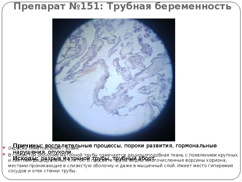 Препарат №151: Трубная беременность  Окраска гематоксилин - эозин.  В