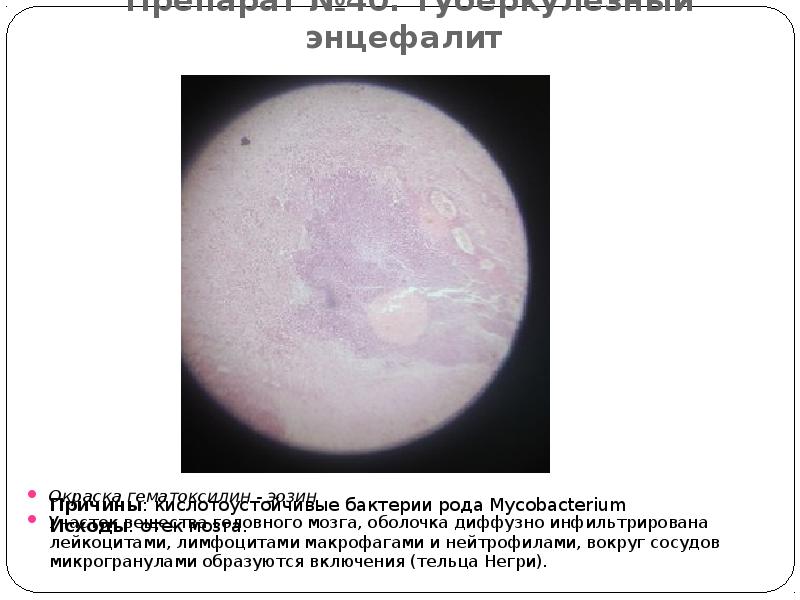 Препарат №40: Туберкулезный энцефалит  Окраска гематоксилин - эозин.  Участок