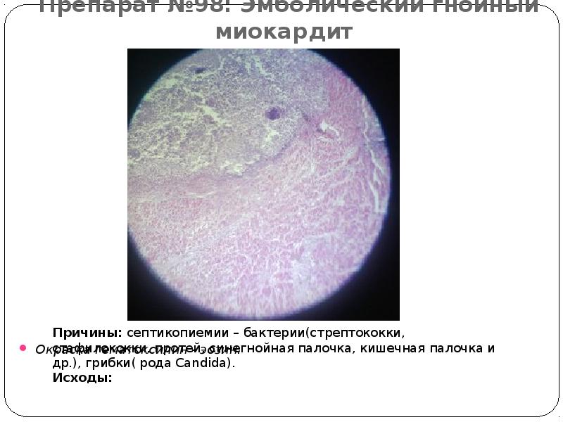 Препарат №98: Эмболический гнойный миокардит  Окраска гематоксилин - эозин.
