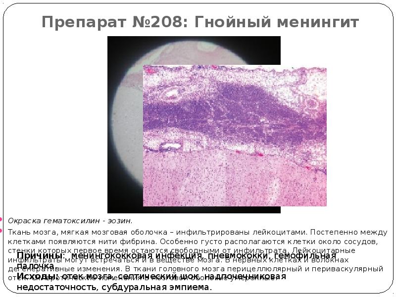 Туберкулезный менингит микропрепарат рисунок