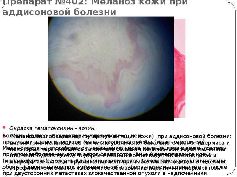 Препарат №402: Меланоз кожи при аддисоновой болезни  Окраска гематоксилин -