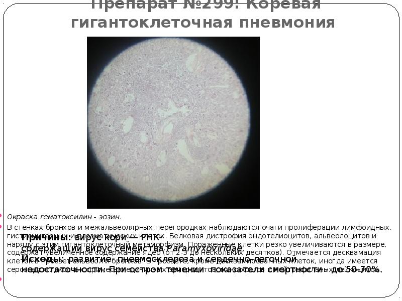 Препарат №299: Коревая гигантоклеточная пневмония  Окраска гематоксилин - эозин. 