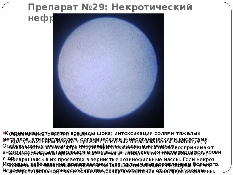 Препарат №29: Некротический нефроз Окраска гематоксилин - эозин.  Коагуляционный некроз