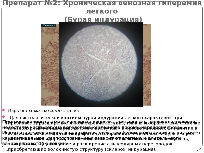 Препарат №2: Хроническая венозная гиперемия легкого  (Бурая индурация) Окраска гематоксилин