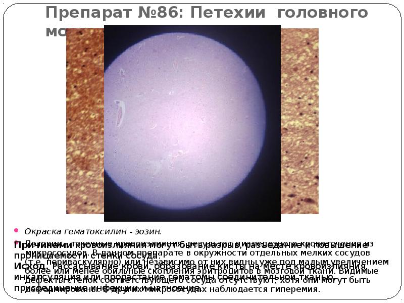 Препарат №86: Петехии головного мозга  Окраска гематоксилин - эозин. 