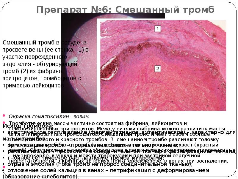 Препарат №6: Смешанный тромб Окраска гематоксилин - эозин.  Тромботические массы