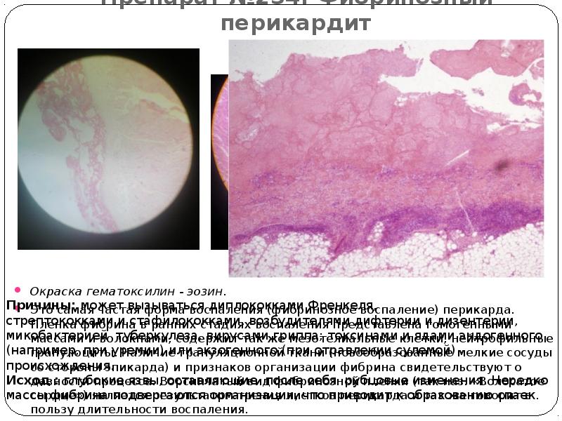 Препарат №234: Фибринозный перикардит Окраска гематоксилин - эозин.  Это самая