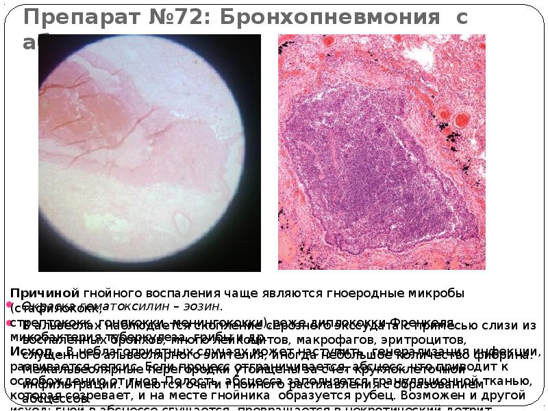 Препарат №72: Бронхопневмония с абсцедированием Окраска гематоксилин – эозин.  В