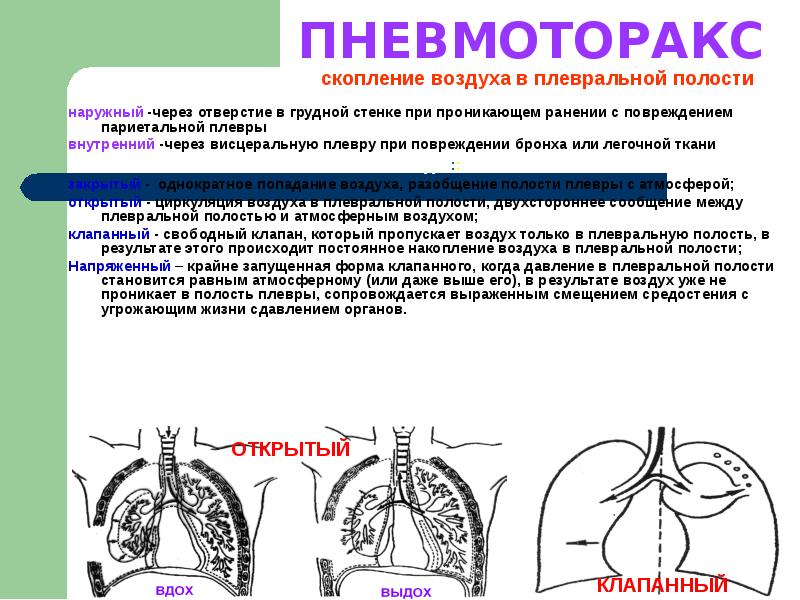 Закрытый пневмоторакс карта вызова