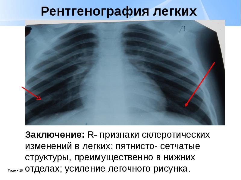 Заключение усиление легочного рисунка