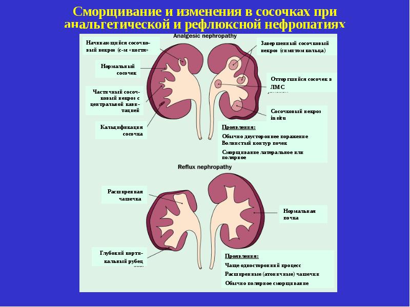 Токсическая нефропатия презентация