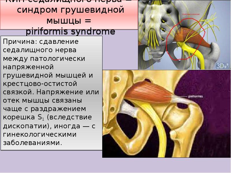 Седалищный нерв и грушевидная мышца фото