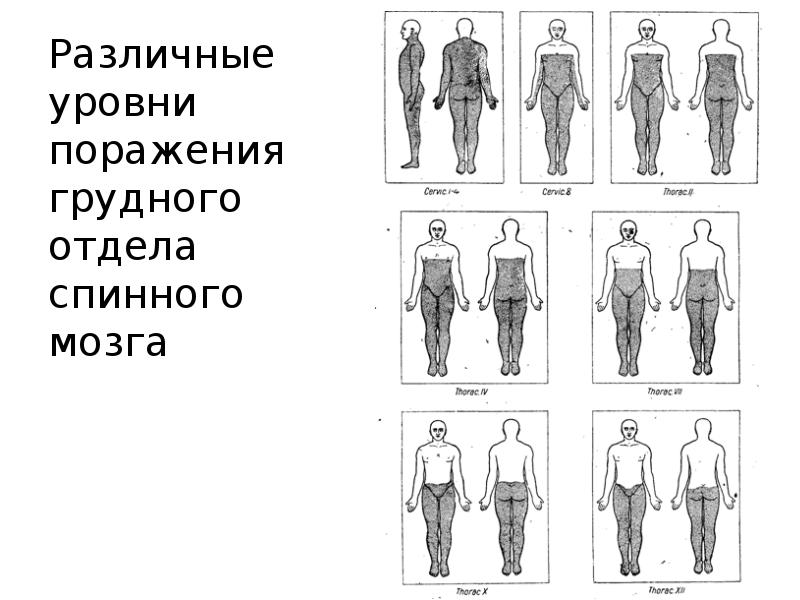 Поражение спинного мозга на различных уровнях