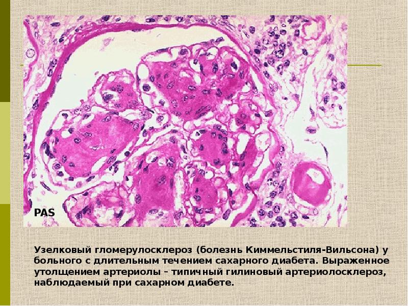 Патологическая анатомия сахарный диабет презентация