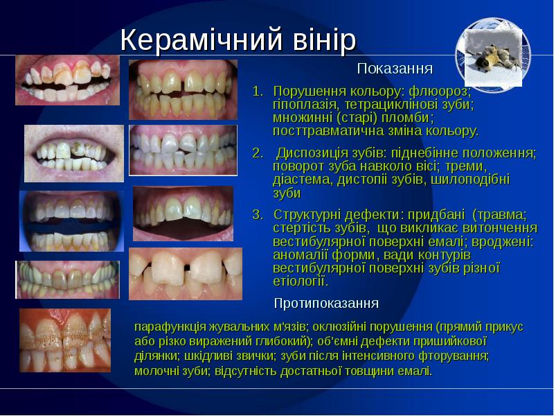 Реферат: Флюороз зубів