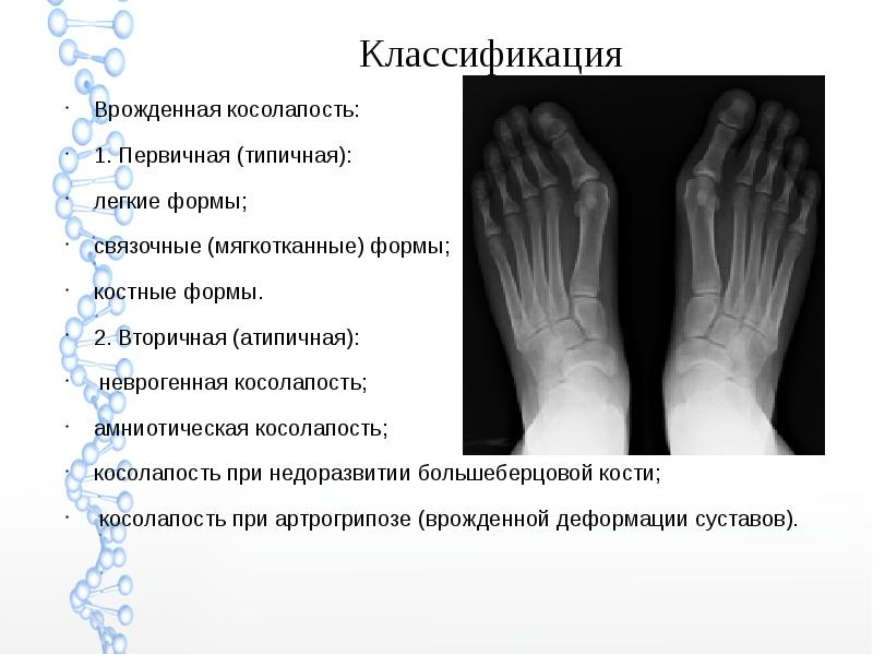 Скачать презентацию дисплазия тазобедренного сустава